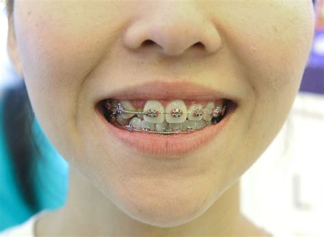 make your own braces